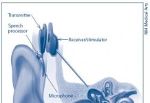 Diagram of a cochlear implant. Credit: National Institutes of Health